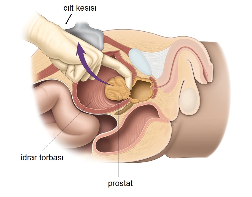 açık prostat